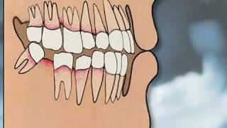 Dental Implants Pros amp Cons  YOU MUST SEE IT [upl. by Ahseeyt]