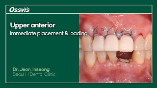 Clinical Case Upper anterior immediate placement amp loading [upl. by Luigino]