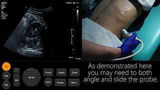 Ultrasound Tutorial Kidney amp Bladder  Urinary Tract  Radiology Nation [upl. by Aela229]