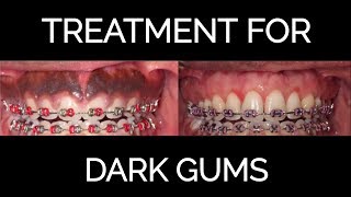 Gum Bleaching Procedure for Black Gums 2018 [upl. by Falk479]