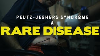 Living with PeutzJeghers syndrome  A short doc [upl. by Aihsercal]