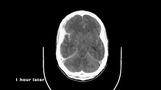 Posterior comunicating artery aneurysm Embolization [upl. by Noyes]