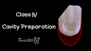 Class 4 Cavity Preparation IV فرح علي FarahAlli98 [upl. by Amsirhc]