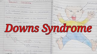 Downs Syndrome  Trisomy 21  Mongolism  Notes With Diagrams To Understand Better  Cx and Features [upl. by Ogilvy784]