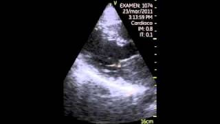 VSCAN left atrial tumor atrial myxoma pocket ultrasound [upl. by Wills]