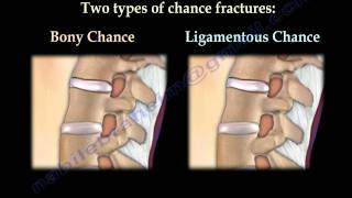 Chance Fractures of the Spine  Everything You Need To Know  Dr Nabil Ebraheim [upl. by Odoric]