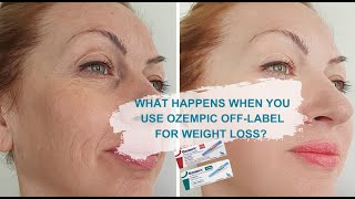 Ozempic Reviews Ozempic WeightLoss Before and After  How Safe Is It [upl. by Egas]