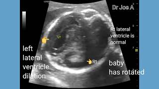 Mild unilateral dilation lateral ventricle in fetus unilateral ventriculomegaly ultrasound video [upl. by Kilam160]