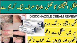 Xirconi cream uses in Urdu  oxiconazole nitrate 1 Benifits  xirconi cream  dosage sideeffects [upl. by Leahplar573]