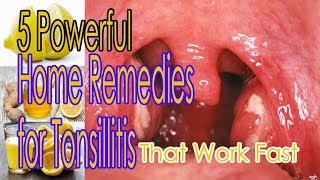 5 Powerful Home Remedies for Tonsillitis That Work Fast [upl. by Whitnell]