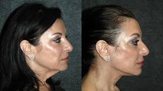 Lower Facelift Without Anesthesia lowerfacelift [upl. by Ytineres]