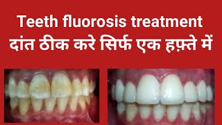 Teeth fluorosis treatment Smile design treatment बदरंग दांतो को ठीक करे Front teeth treatment [upl. by Asined]