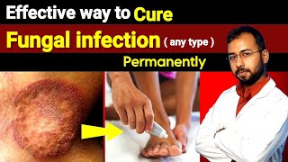 Best antifungal cream for fungal infection  ringworm  how to get ride of fungal infection [upl. by Victorine]