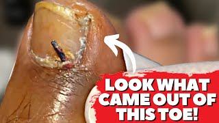 DEEP Thorn Removal From Toe 😨 Home Remedy To Remove Foreign Body From Toe [upl. by Gine]