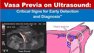 Vasa previa on Ultrasound [upl. by Ahtennek966]