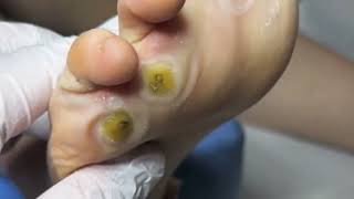 Pedicure video30，vertical plantaris，plantar wart [upl. by Darnoc860]