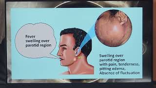 Parotid Abscess Hindi  Patient teaching programme [upl. by Seta867]