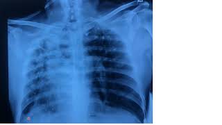 Chest X Ray Lesson 10  Fibrosis [upl. by Studdard]