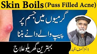 Puss Filled Acne CausesSymptoms And Treatment In Urdu [upl. by Ylera]