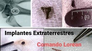 Implantes extraterrestres como identificar se são positivos ou negativos [upl. by Suvart]