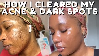 HOW I CLEARED MY ACNE BREAKOUTS AND DARK SPOTS NO TRETINOIN  iJay Amadi [upl. by Eelaroc560]