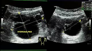 ultrasound video shows left hydrosalpinx [upl. by Aitnas355]