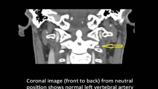 Vertebrobasilar Artery Syndrome  Bowhunters Syndrome  Colorado Spine Surgeon [upl. by Ashmead]