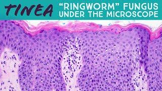 quotRingwormquot under the microscope tinea dermatophytosis fungal folliculitis Majocchi pathology [upl. by Thetos]