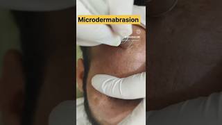 Microdermabrasion Treatment✨ Dr Fouzia Baig ☎️ 8851204180 drfouziaclinic youtubeshorts amroha [upl. by Paresh153]