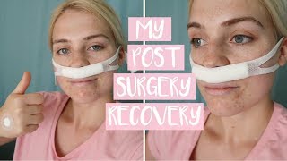 WHAT TO EXPECT AFTER NASAL SURGERY  First Week of PostSinus Septoplasty Operation Recovery [upl. by Nauqes]