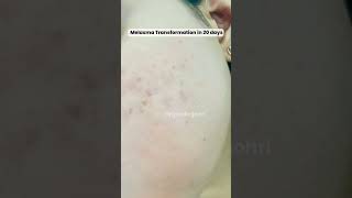 Dark Spot Treatment in 20 days Melasma Skinfinity Derma [upl. by Roseline517]