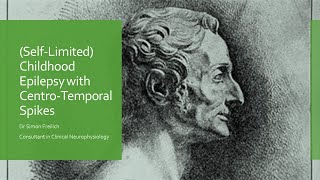 Childhood Epilepsy with Centro Temporal Spikes Originally Rolandic Epilepsy [upl. by Eineg]