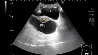 Ultrasound Video showing multiple findings in patient suffering from viral hepatitis [upl. by Anuahc865]