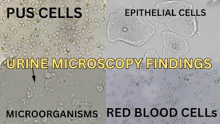 Pus cells  Epithelial cells Red blood cells and microorganisms seen in urine microscopy urine [upl. by Ilah904]