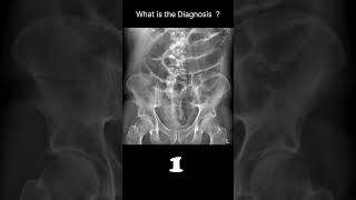 Postoperative ileus Abdominal Xray Abnormalities Postoperative ileus 66 radiologychannel007 [upl. by Nirihs136]