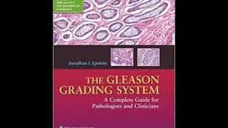 The Gleason Grading System A Complete Guide for Pathologist and Clinicians [upl. by Anthe676]