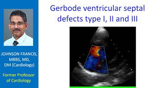 Gerbode ventricular septal defects type I II and III [upl. by Casia]