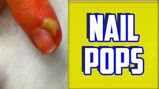 Top 4 Paronychia amp Nail Infections of All Time [upl. by Reniti]