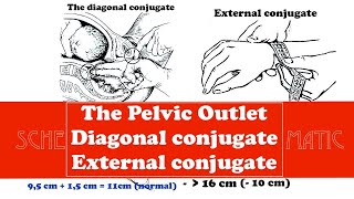 The Pelvic Outlet Diagonal conjugate and External conjugate [upl. by Renat]