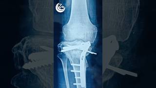 Intraarticular osteotomy [upl. by Clemente977]