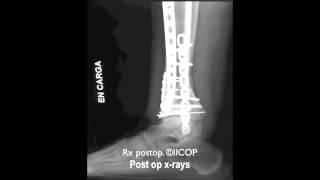 SECUELA DE FRACTURA DE PILON TIBIAL TRATADA MEDIANTE OSTEOTOMIA DE TIBIA DISTALmov [upl. by Elka]