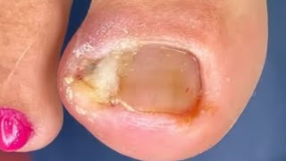 ELA ACHOU QUE ERA APENAS UM CÁNTINHO e OLHA O QUE SAIU 😷😱 Kelly Freitas podologia nails [upl. by Brandon]