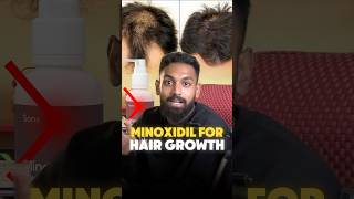 Minoxidil for hair reels viralvideo haircare hair [upl. by Melantha114]