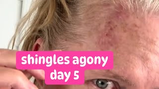 Shingles day 5 update [upl. by Niras]