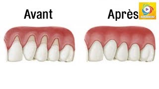 Arrêtez la rétraction de vos gencives et soignezla avec ces remèdes naturels  Random888 [upl. by Kiele817]