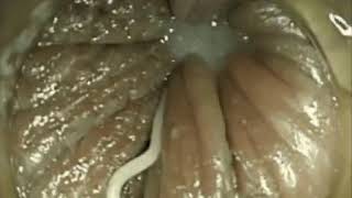 Enterobius vermicularisPinworm Infection [upl. by Ecirted]