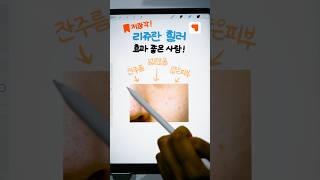 리쥬란힐러 효과 보는 피부 타입 리쥬란힐러 gangnamunnikr [upl. by Aerdnu]