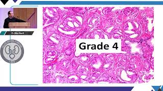 Anatomopathologie du cancer de prostate [upl. by Rich]