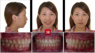 Correction of Skeletal Class ll Malocclusion｜【Chris Chang Ortho】CC423 [upl. by Anahsak]