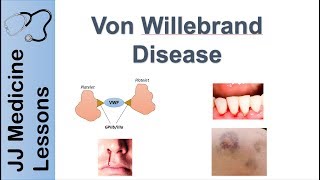 Von Willebrand Disease  Pathophysiology Types Symptoms and Treatment [upl. by Nosrej757]